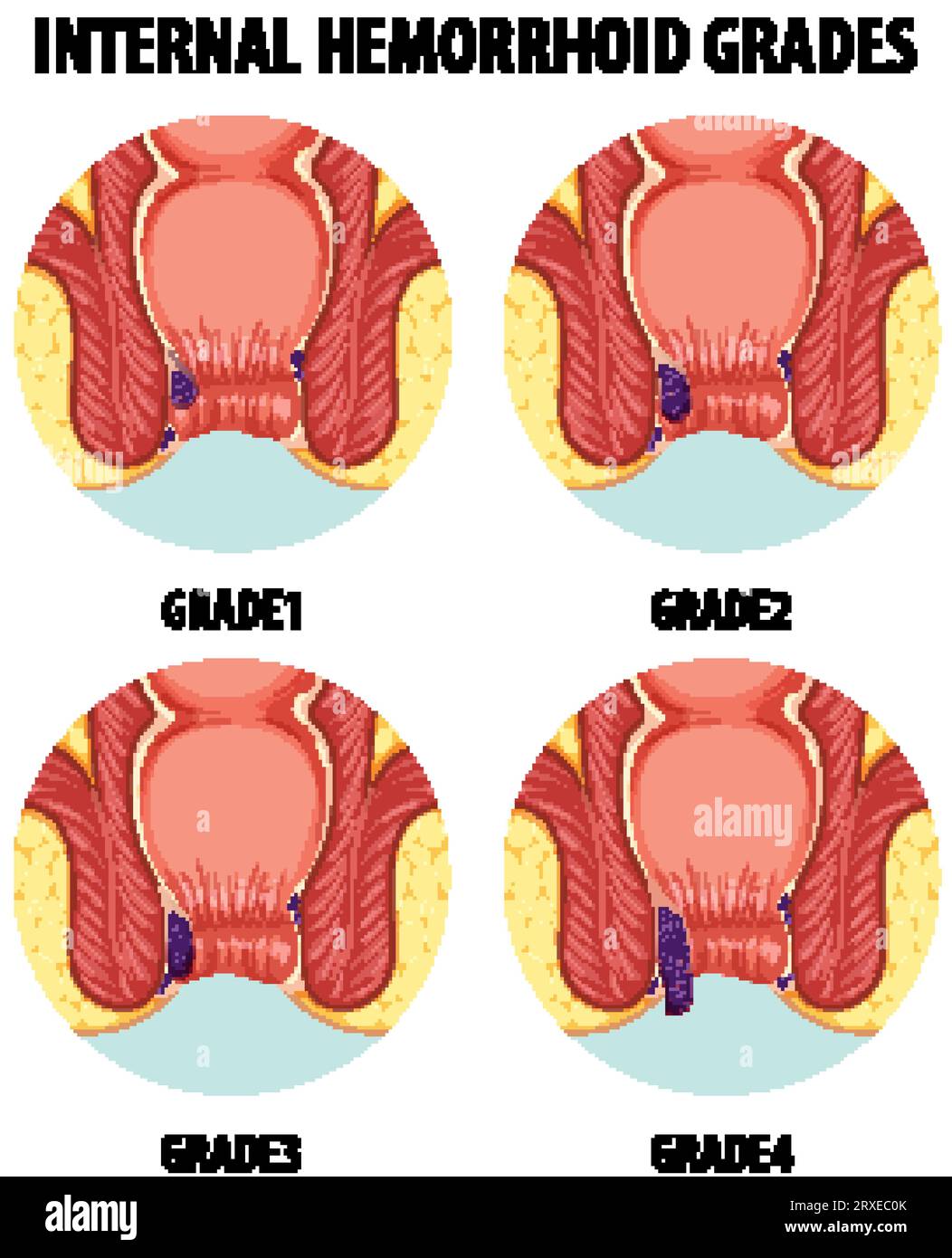 Hemorrhoidectomy 2024