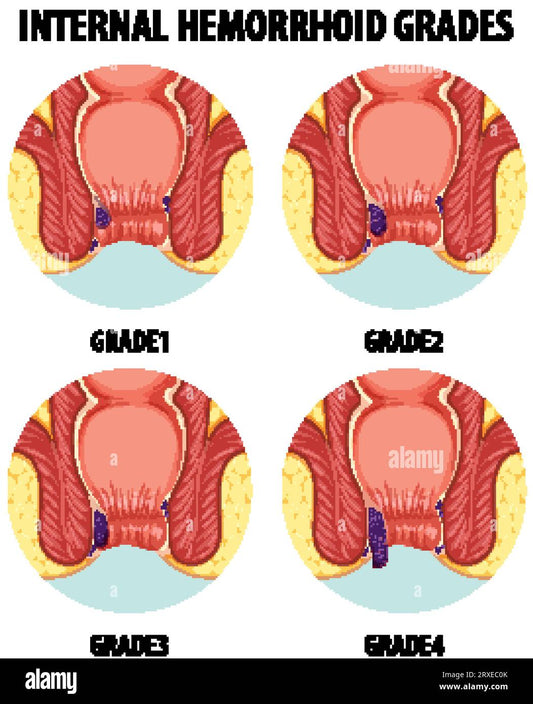 Hemorrhoidectomy 2024